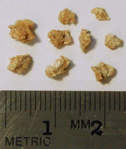 Fragments passés après lithotritie d'un calcul de 1 cm