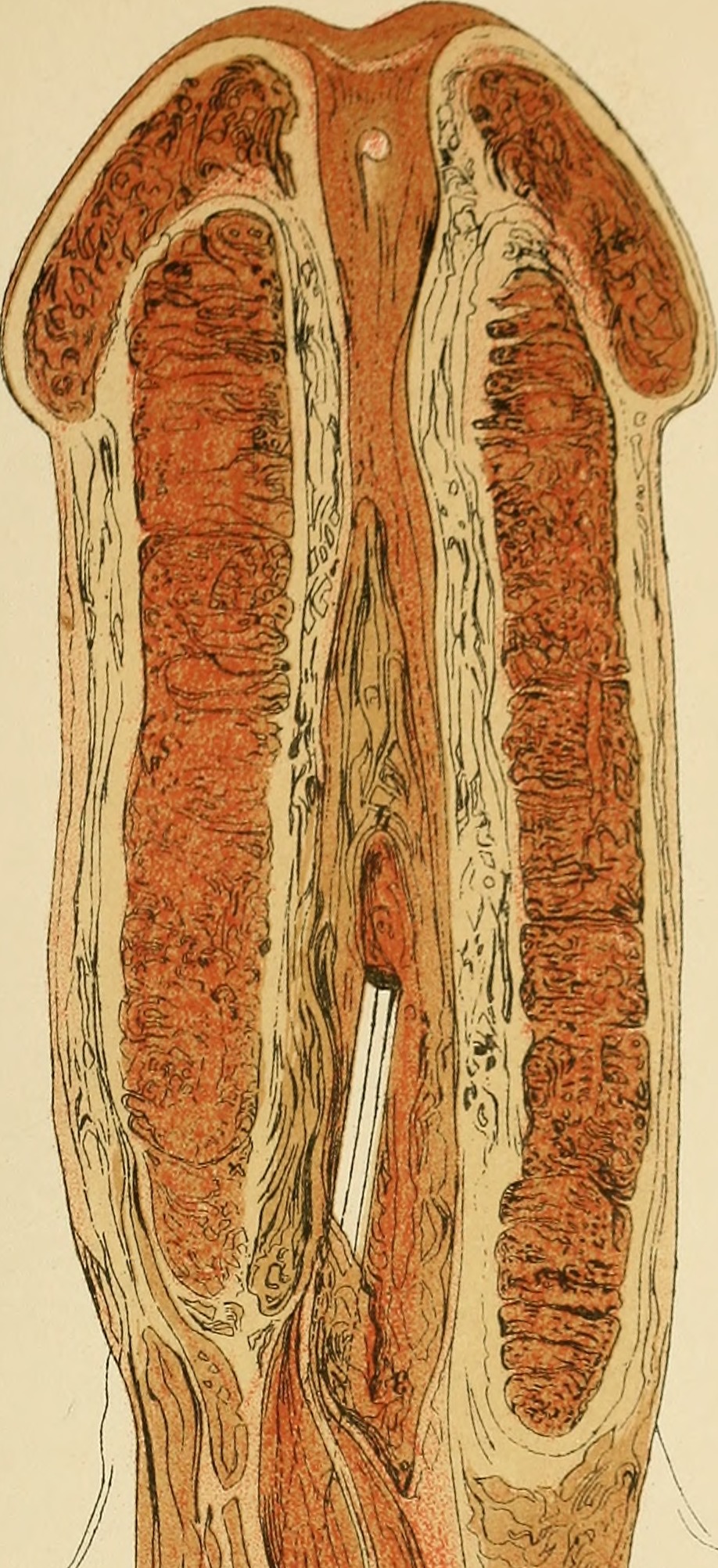 Instrument urétral — risque de fausse route