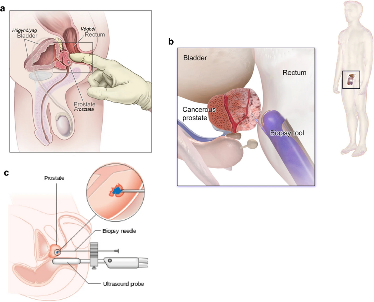 Parcours diagnostiqué du cancer de la prostate