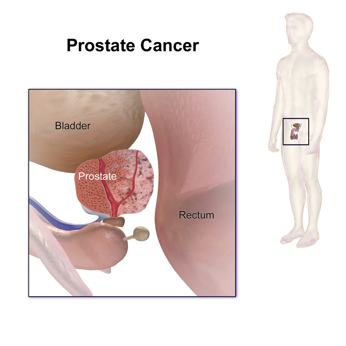 Vue d'ensemble du cancer de la prostate