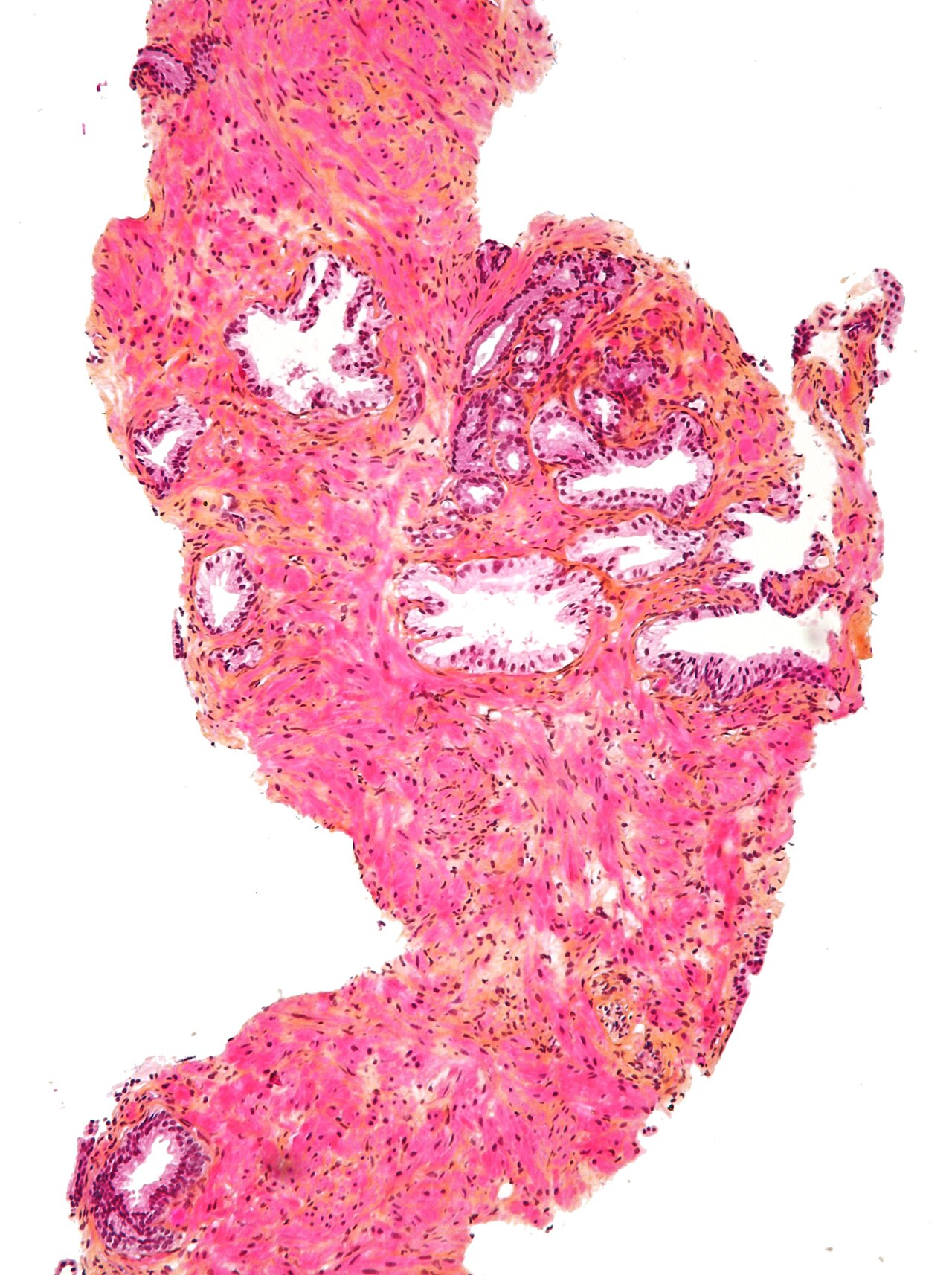Adénocarcinome prostatique — microscopie