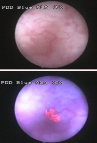 Cystoscopie en lumière bleue — vue endoscopique