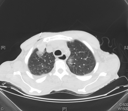 TDM injectée — carcinome rénal