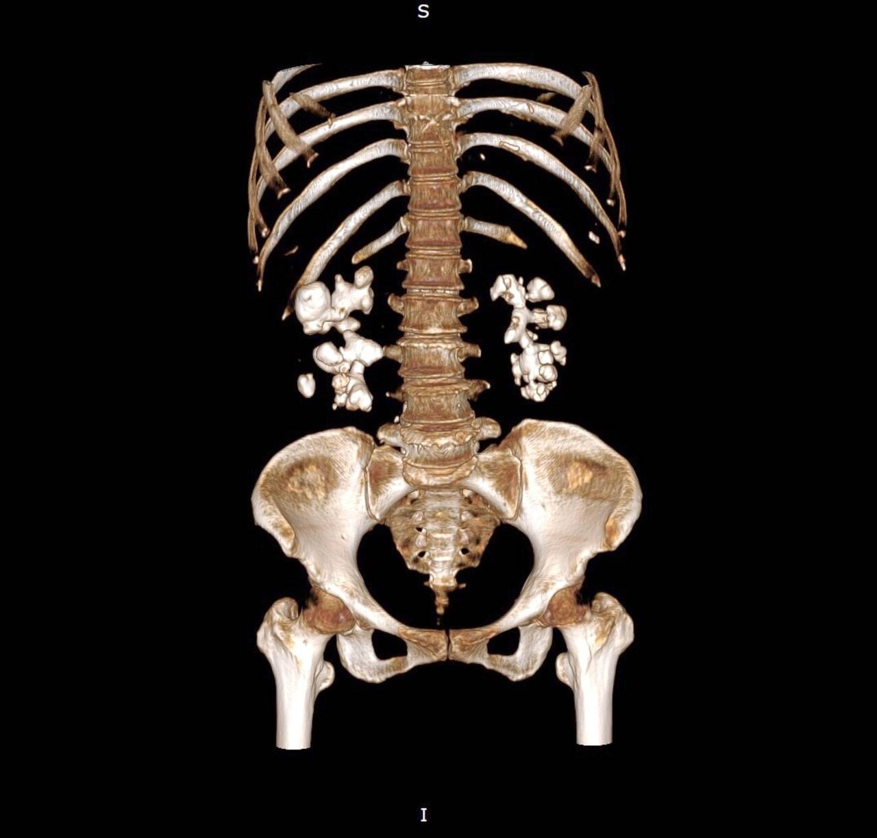 TDM sans injection — lithiase