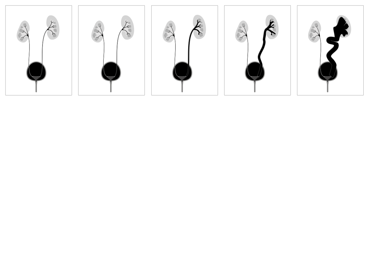 Classification RVU I-V