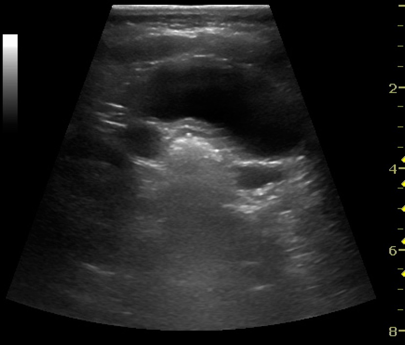 Dilatation bilatérale par RVU