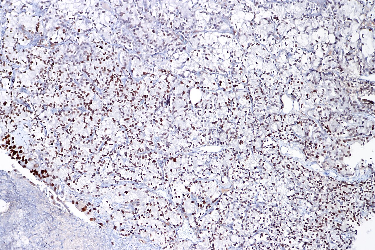 Immunohistochimie (GATA3) — les techniques IHC servent aussi pour le PD-L1