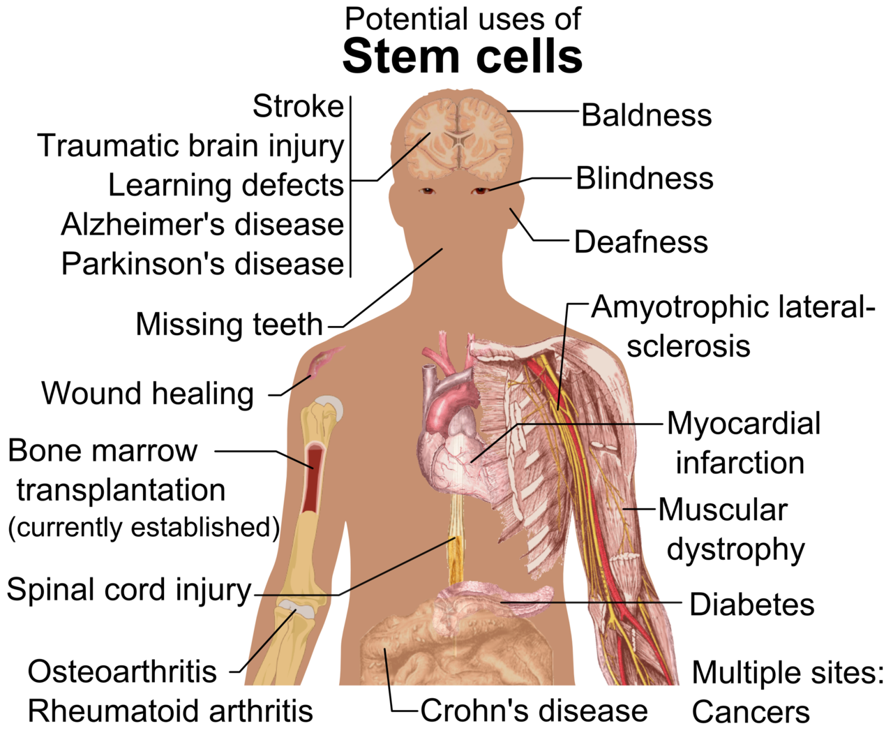 Pathologies ciblées par les cellules souches