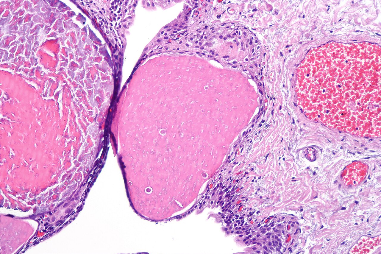 Cystite kystique — nids d'urothelium avec lumieres dilatees