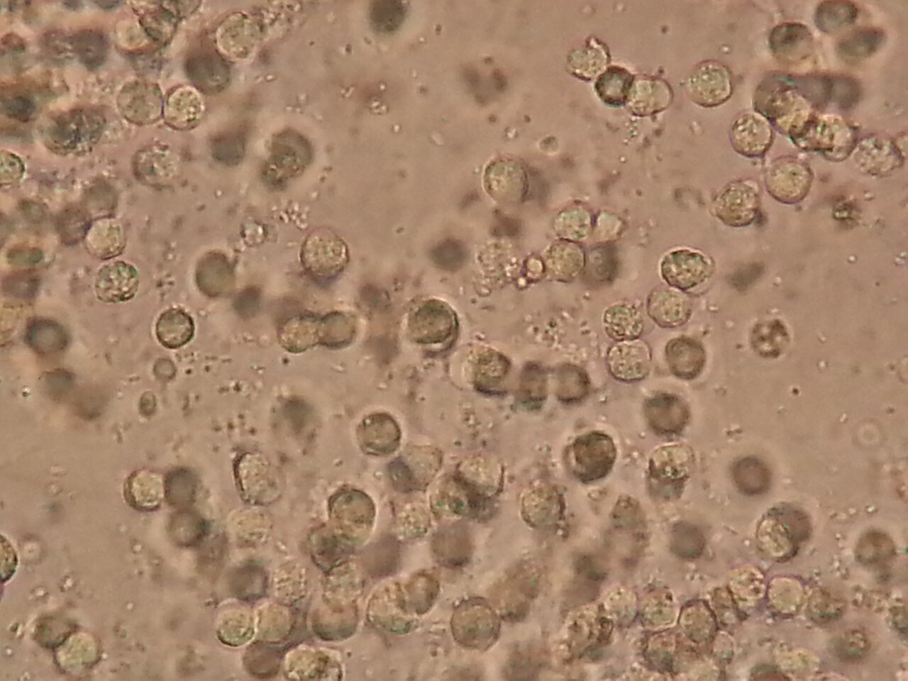 Examen microscopique d'urines : leucocytes et bacteries