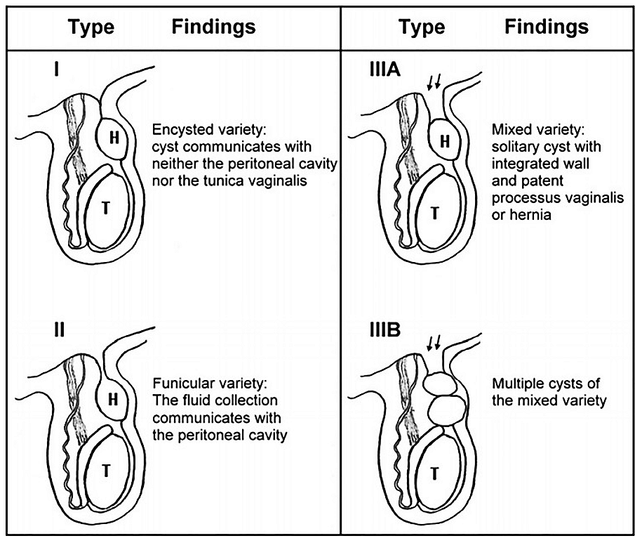 Classification des hydrocèles — schéma diagnostique