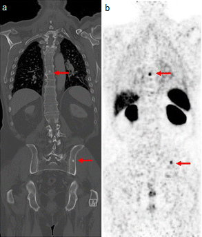 TEP-PSMA au 68Ga chez un patient de 78 ans