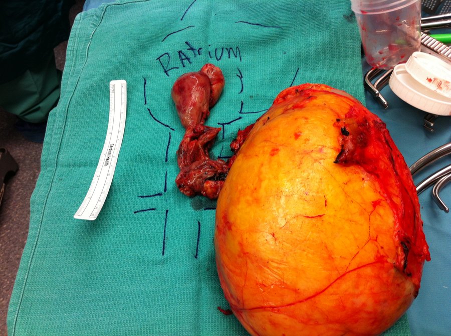 Thrombus tumoral veineux