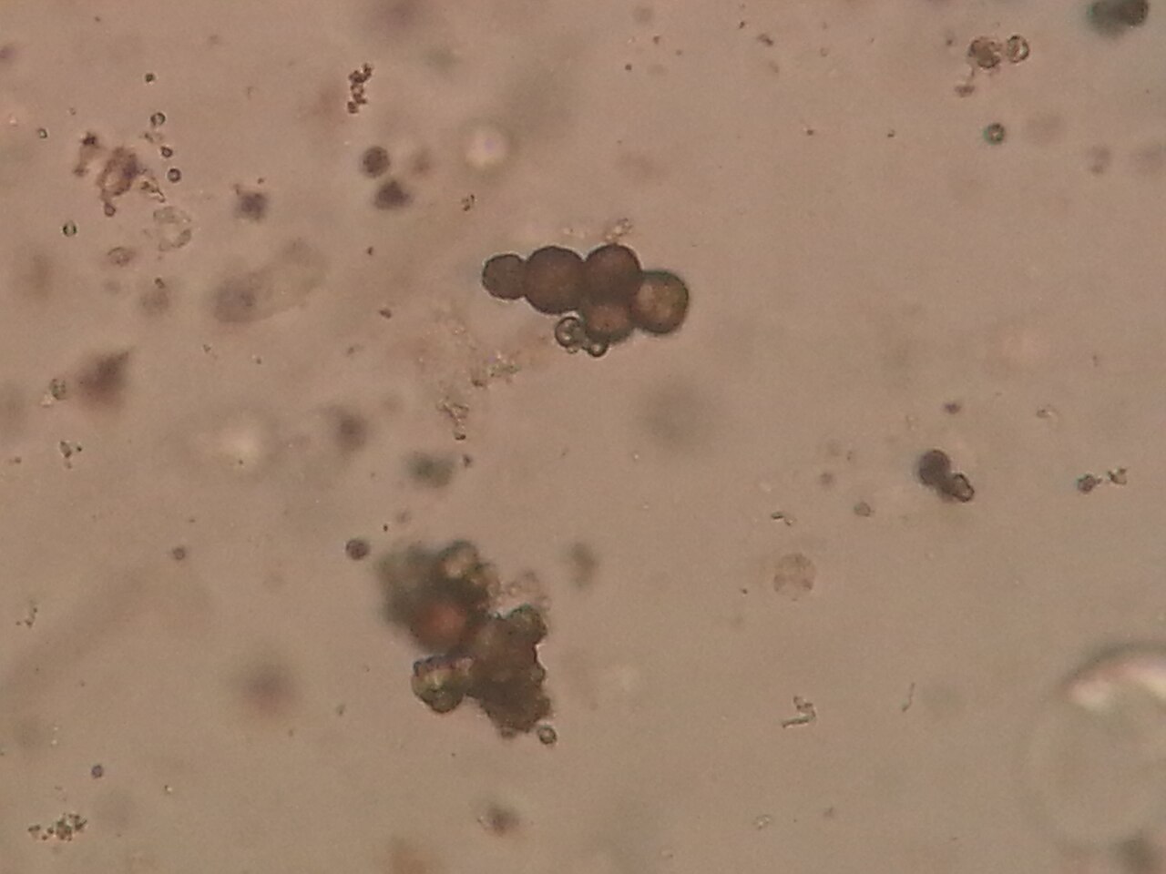 Cristaux de carbonate de calcium dans les urines