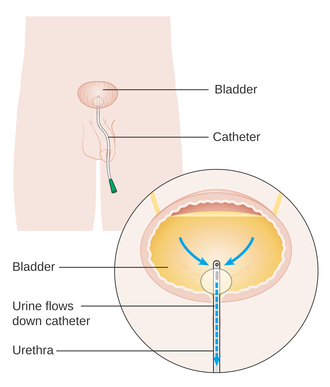 Sonde urinaire après chirurgie prostatique