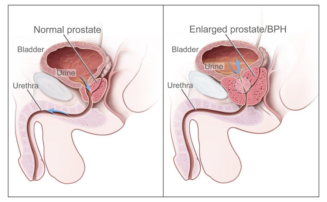 HBP — prostate normale vs hypertrophiée