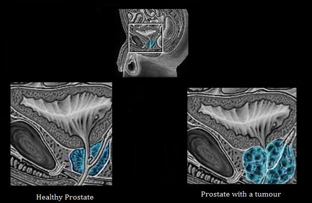 Prostate saine vs tumorale