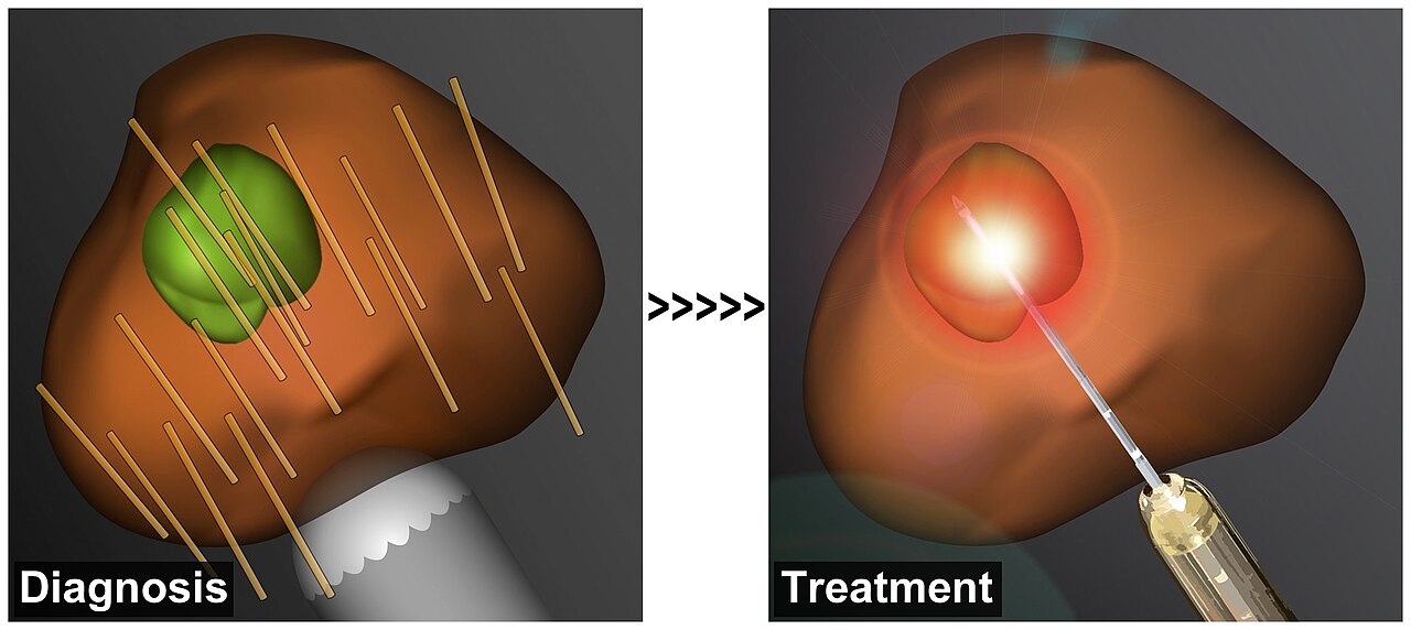 Biopsie ciblée et traitement focal