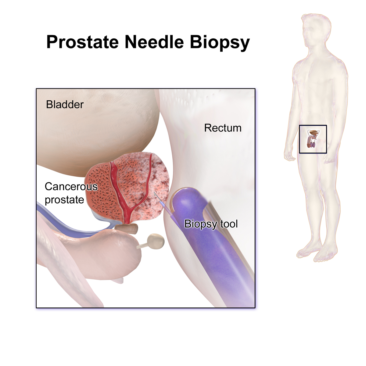Biopsie prostatique — voie d'accès similaire à la LITT