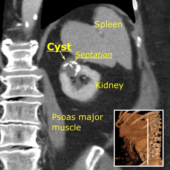 Scanner abdominal — tumeur rénale ciblé de cryoablation
