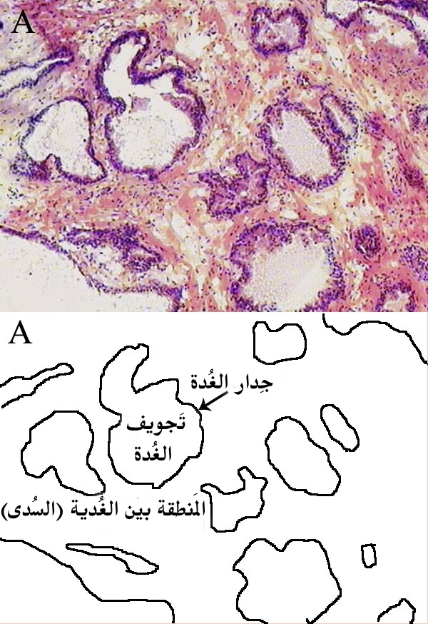 Histologie prostatique — tissu ciblé de la vaporisation