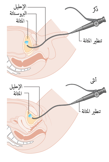 Cystoscopie — voie d'implantation de l'iTIND