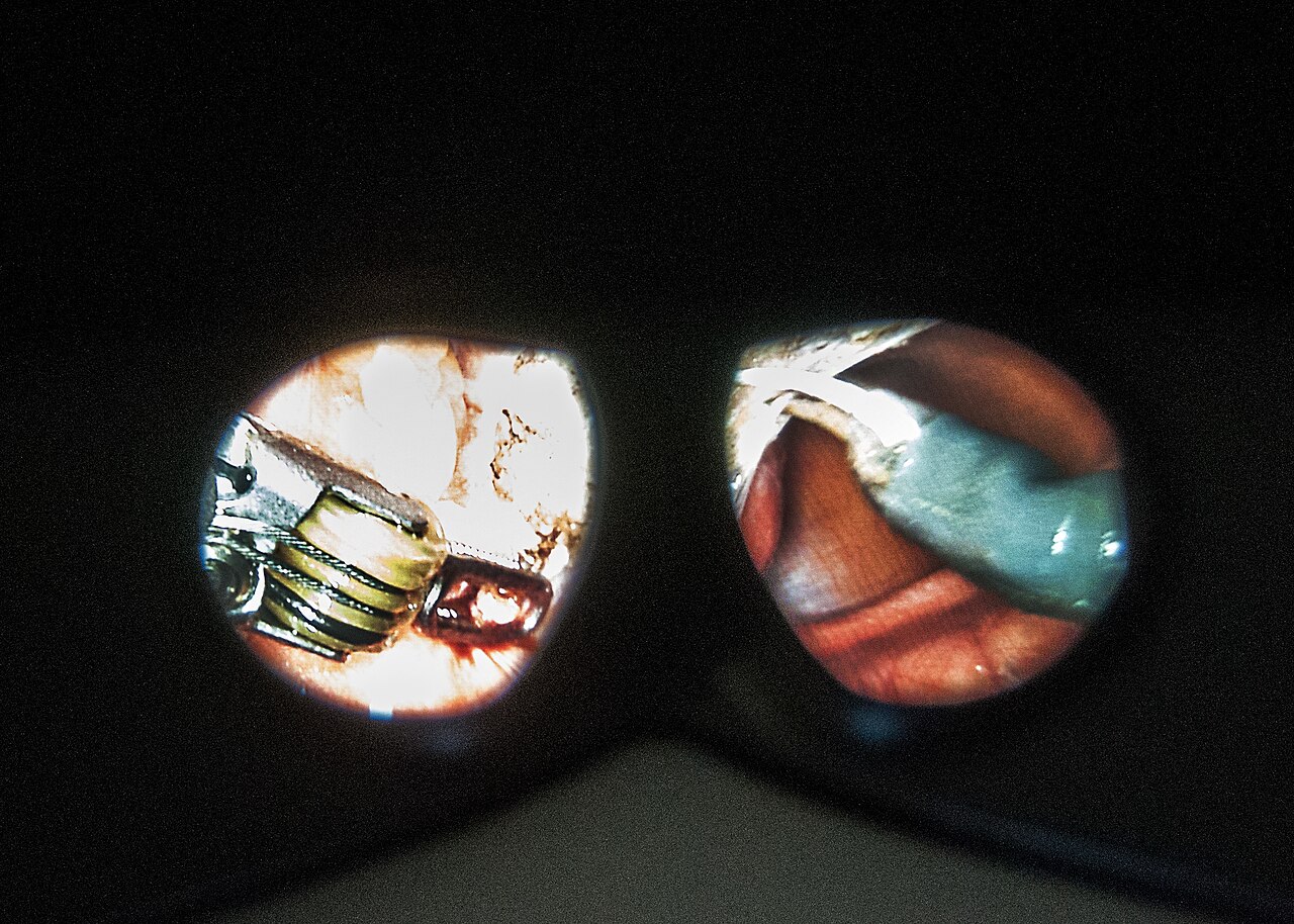 Vision endoscopique — chirurgie prostatique