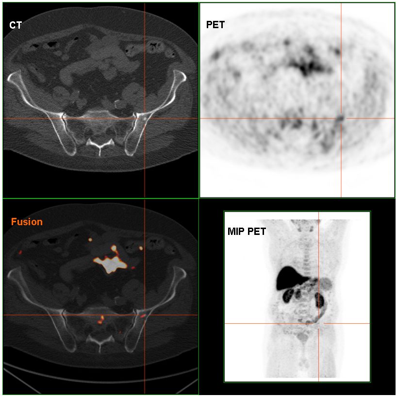 Métastases osseuses ostéocondensantes du cancer de prostate