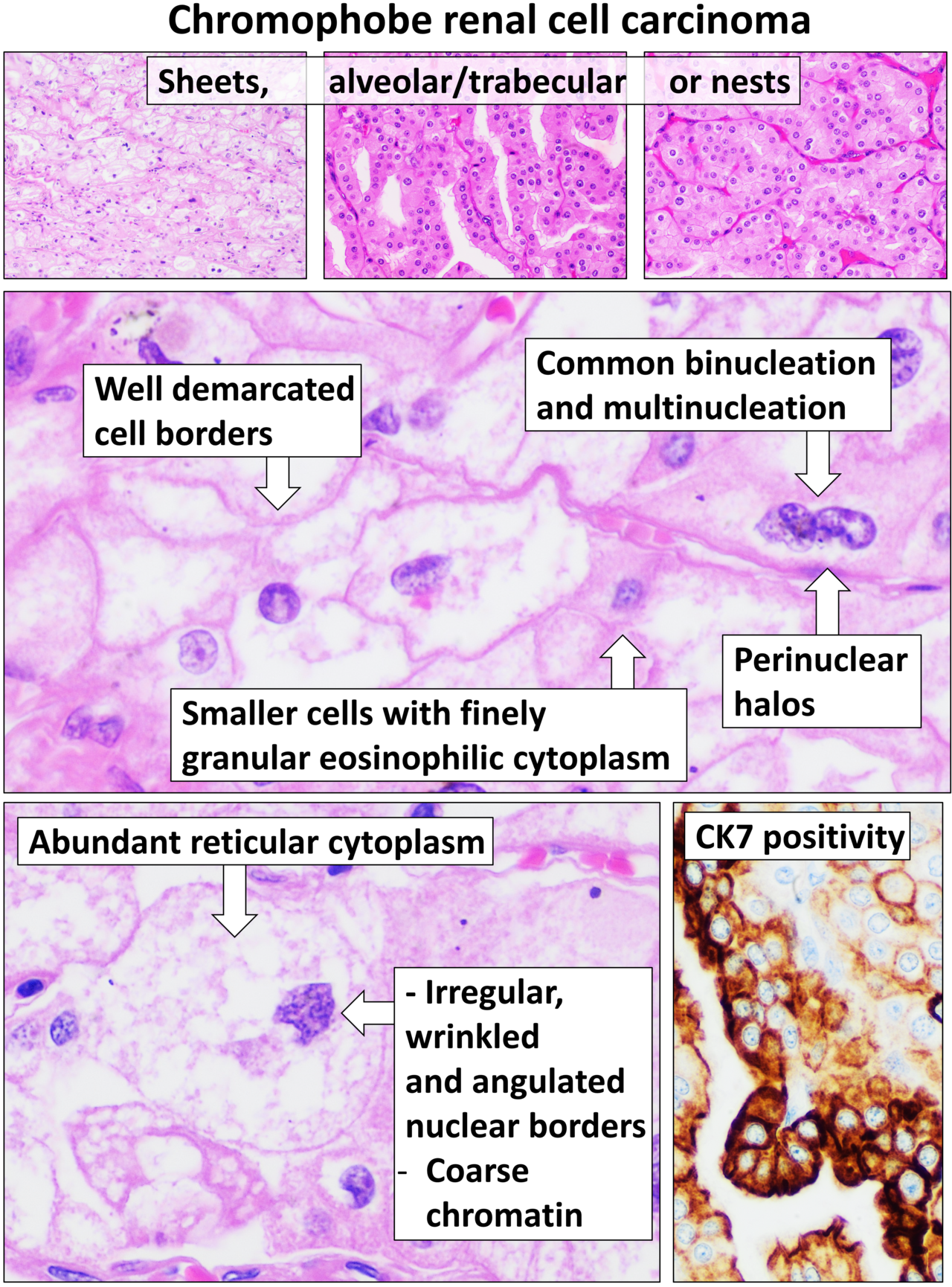 Histopathologie du carcinome rénal chromophobe (HE)