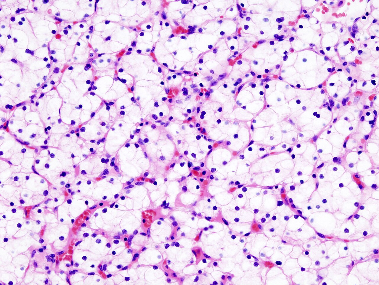 Pièce de néphrectomie — carcinome à cellules claires