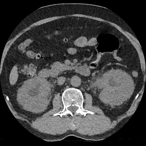 Pyélonéphrite bilatérale au scanner — hypodensités parenchymateuses