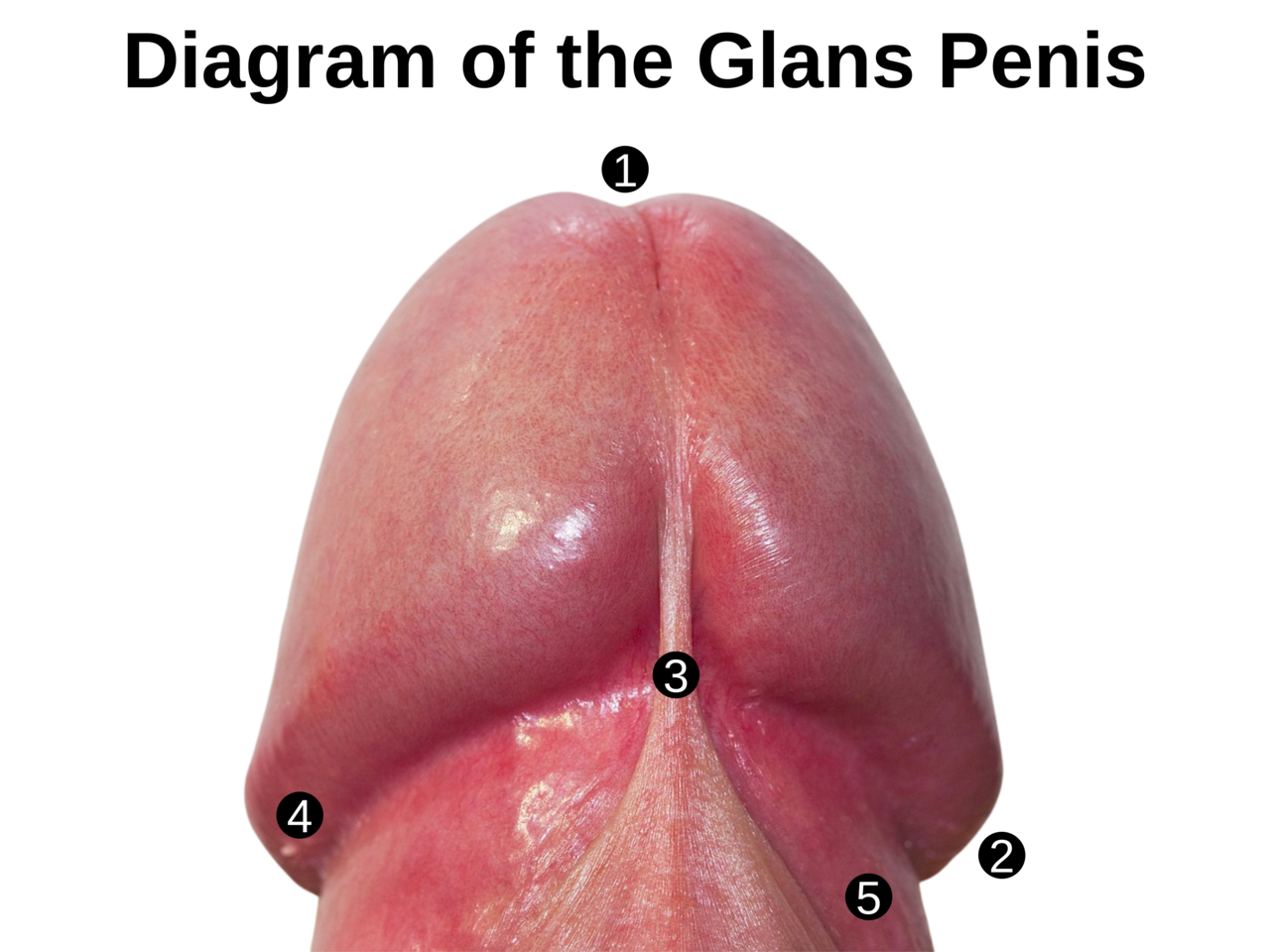 Image annotee du gland penien — zones a surveiller