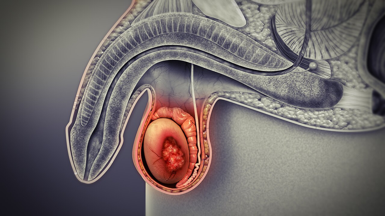 Schema d'une masse testiculaire palpable