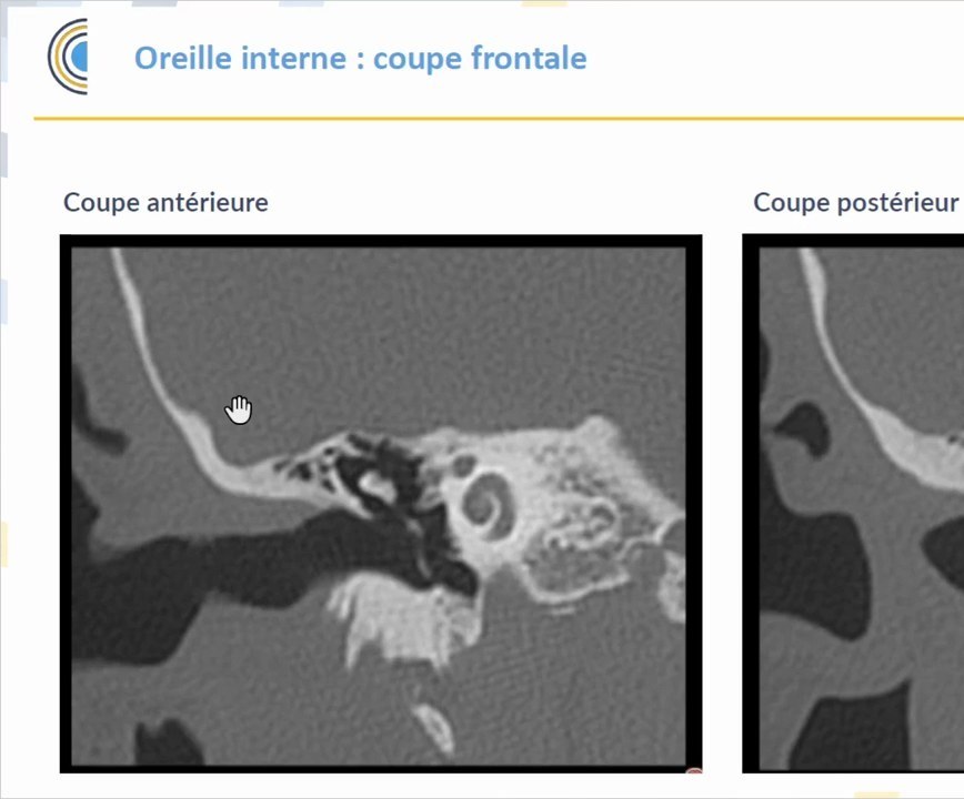 Imagerie ORL - TDM et IRM