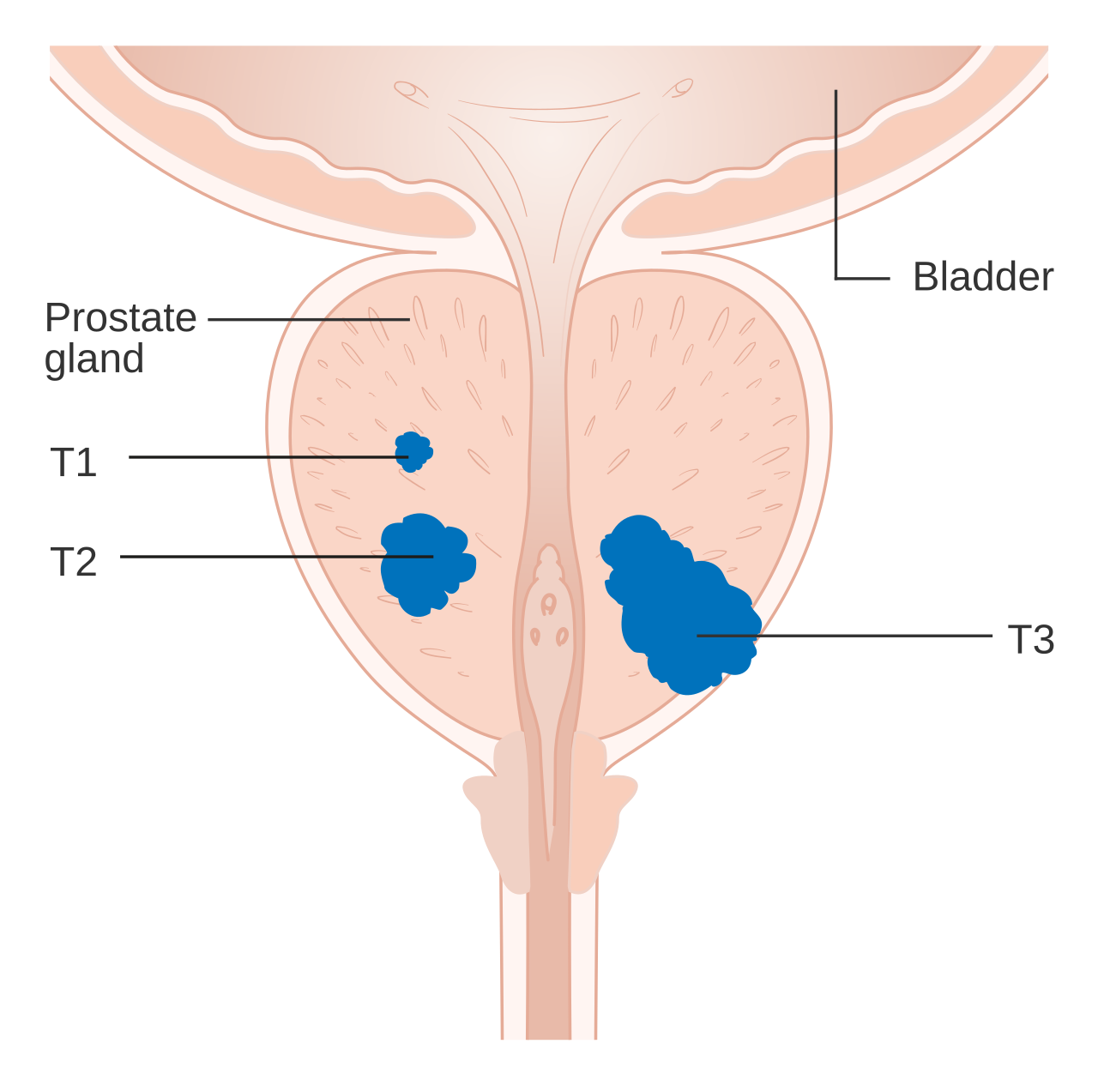 Stades T1-T3 du cancer de prostate