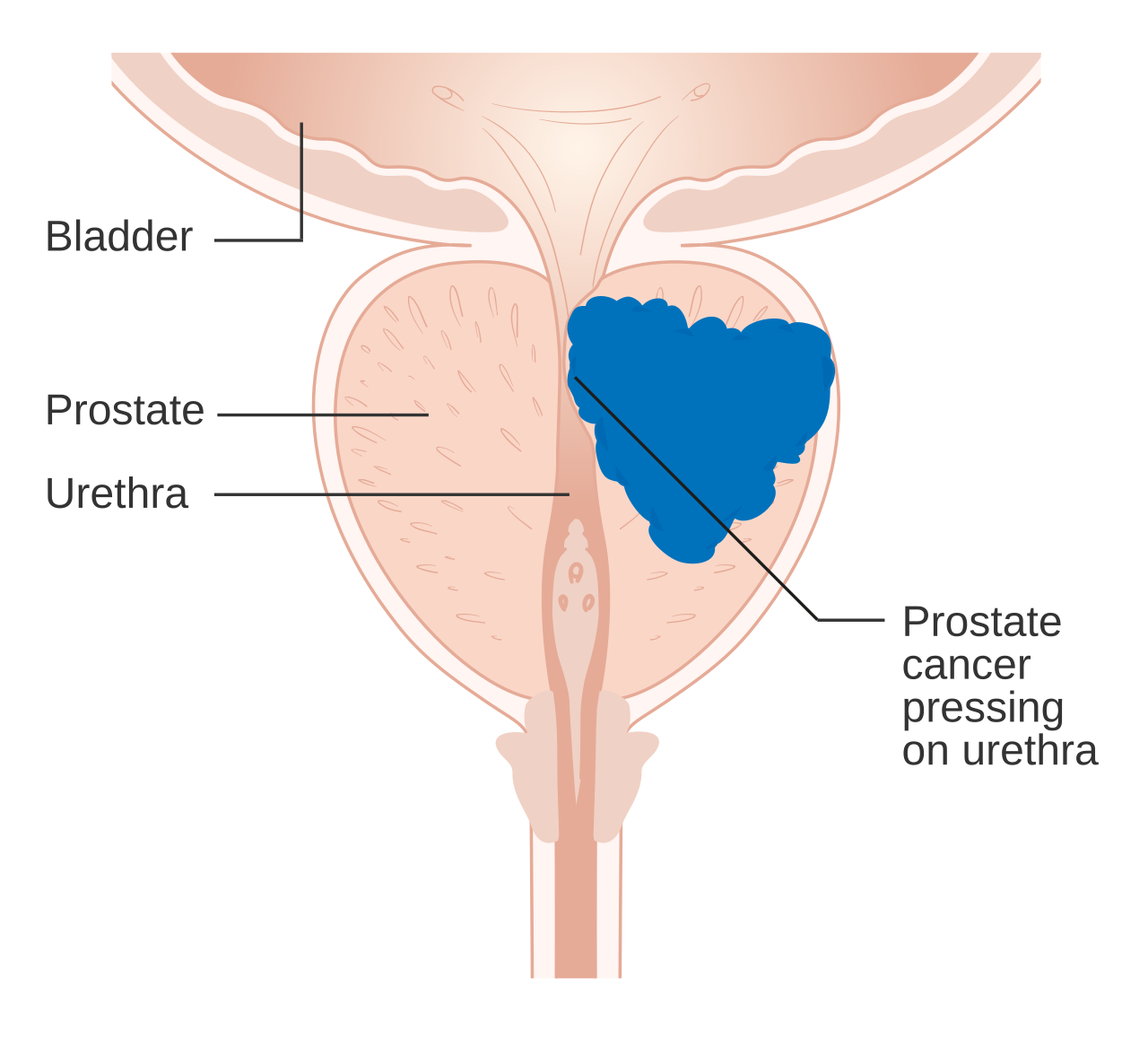 Cancer de prostate comprimant l'urètre