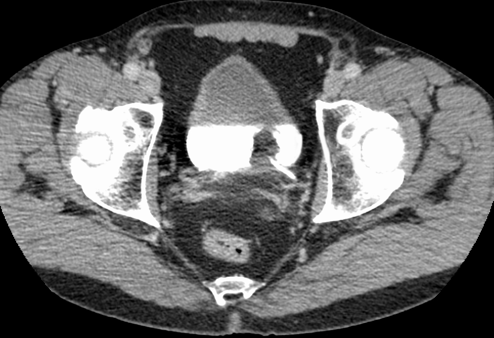 Carcinome urothélial de la vessie
