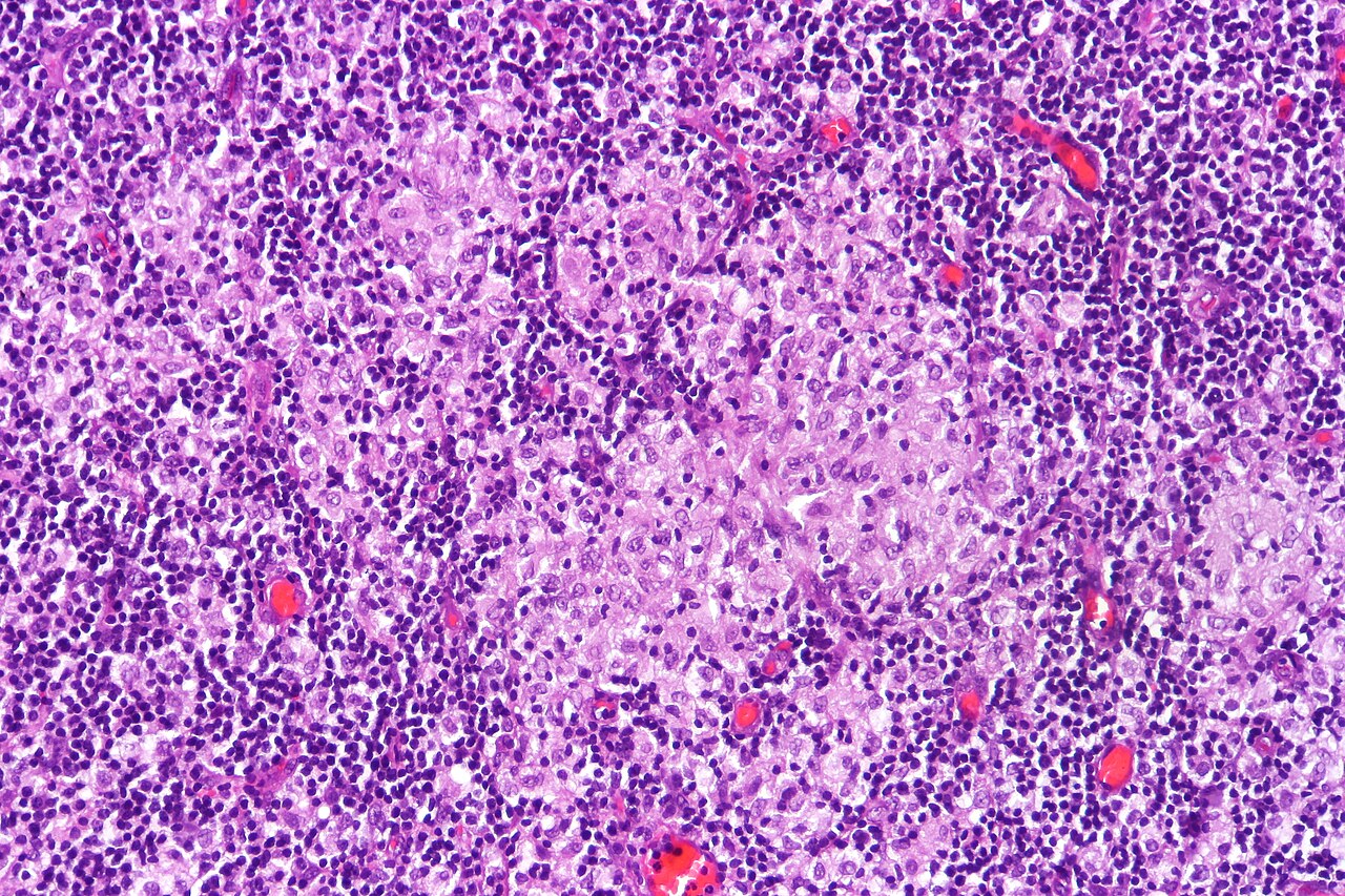 Cystite à BCG — histologie