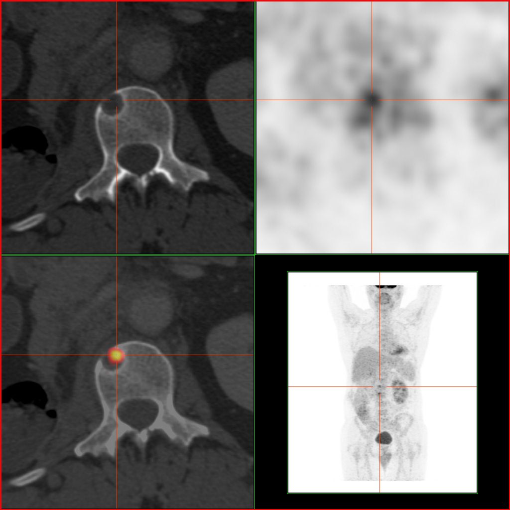 TEP-FDG d'une métastase osseuse de cancer du rein