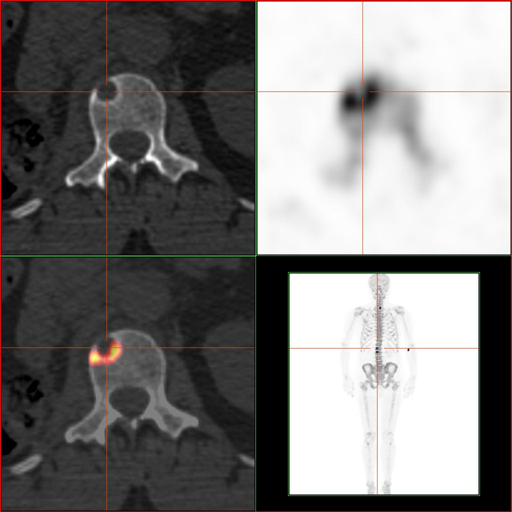 TEP-TDM au NaF : métastase osseuse de cancer du rein, fixation intense sur remodelage osseux