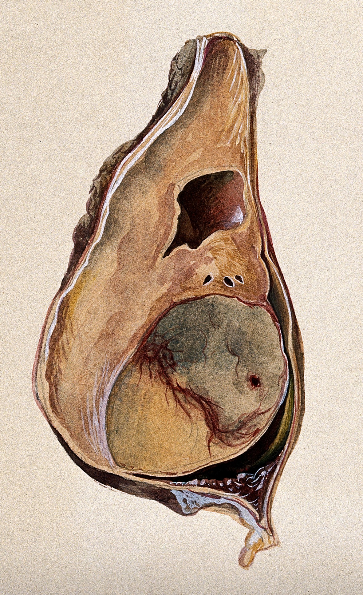 Cancer testiculaire avancé avec métastases chez un homme de 66 ans