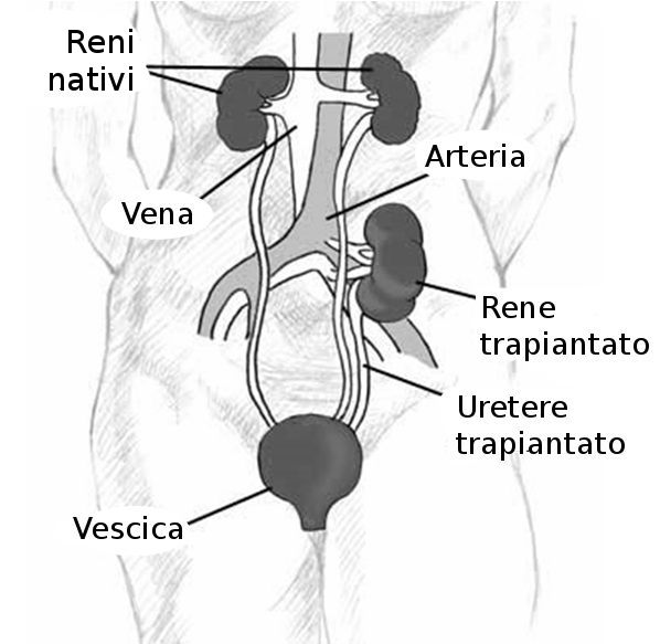 Transplantation rénale : schéma adapté montrant la position du greffon et ses anastomoses vasculaires