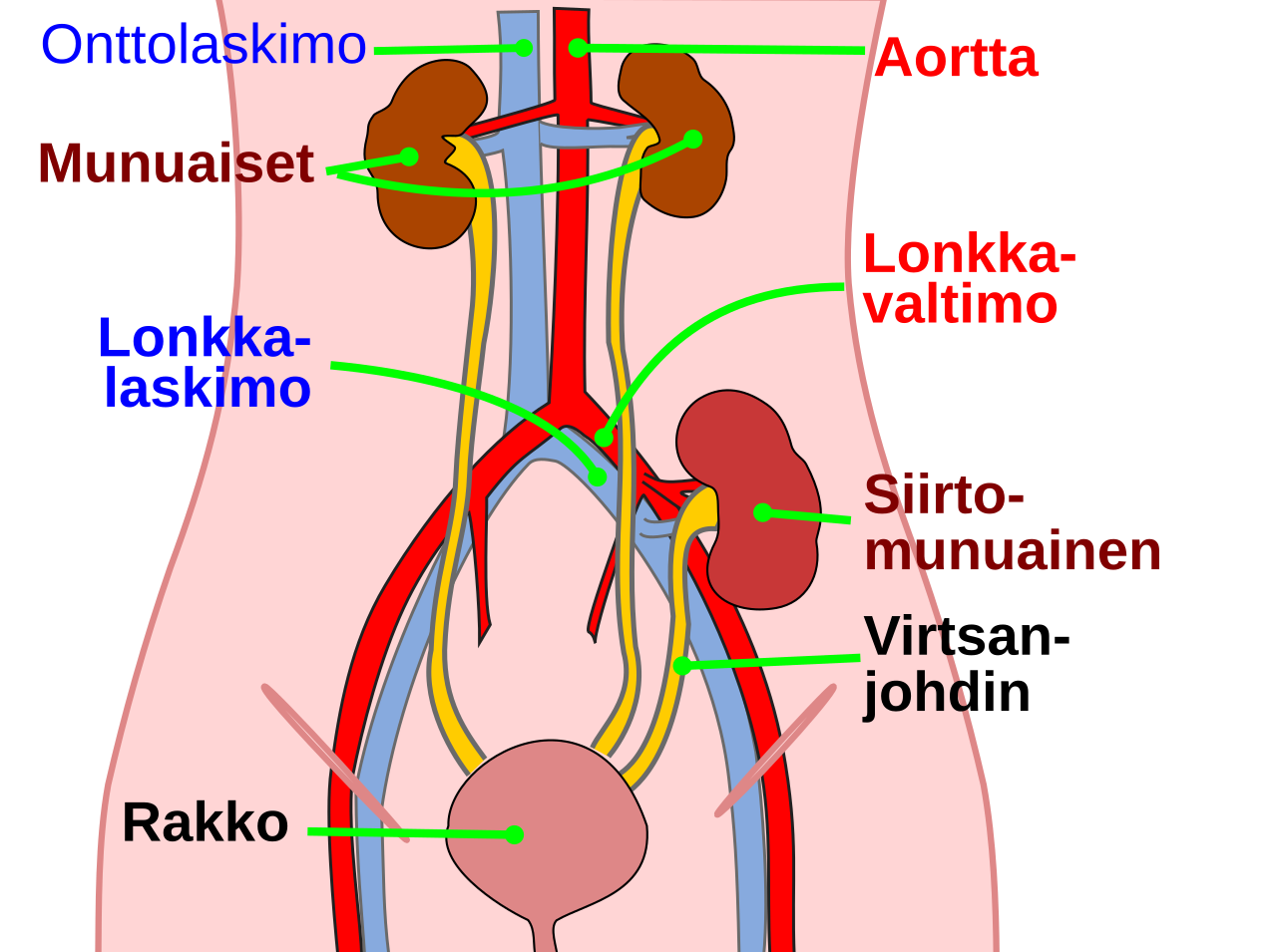 Position du transplant rénal après greffe — illustration finlandaise