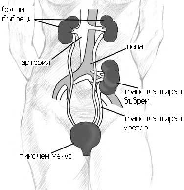 Transplantation rénale — schéma avec légendes
