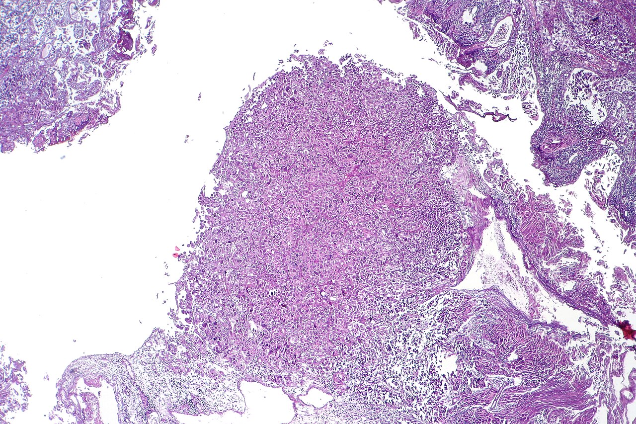 Carcinome urothélial invasif avec cellules géantes anaplasiques