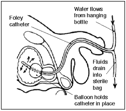 Sonde à demeure de Foley en place