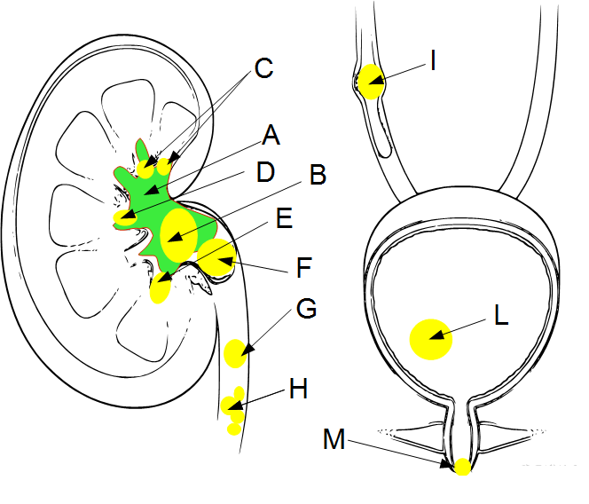 Classification des calculs urinaires par position : rein, uretère, vessie