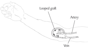 Prothèse vasculaire (graft) pour hémodialyse
