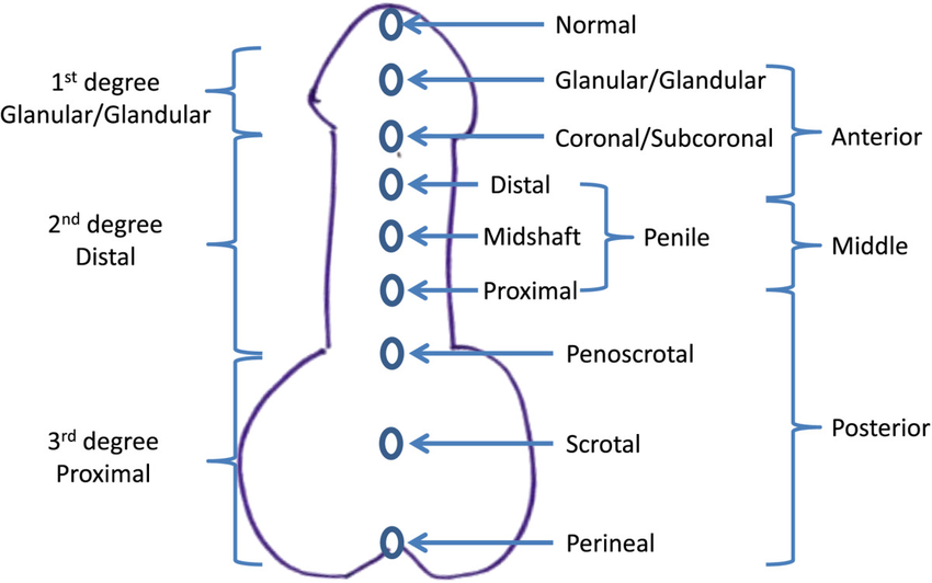Classification des hypospadias selon la localisation du méat urétral (antérieur, moyen, postérieur)