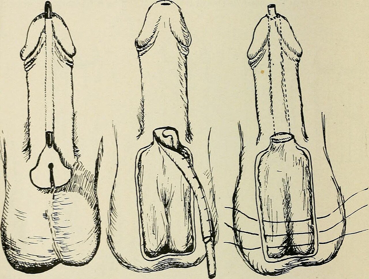 Illustration chirurgicale de plastie pénienne